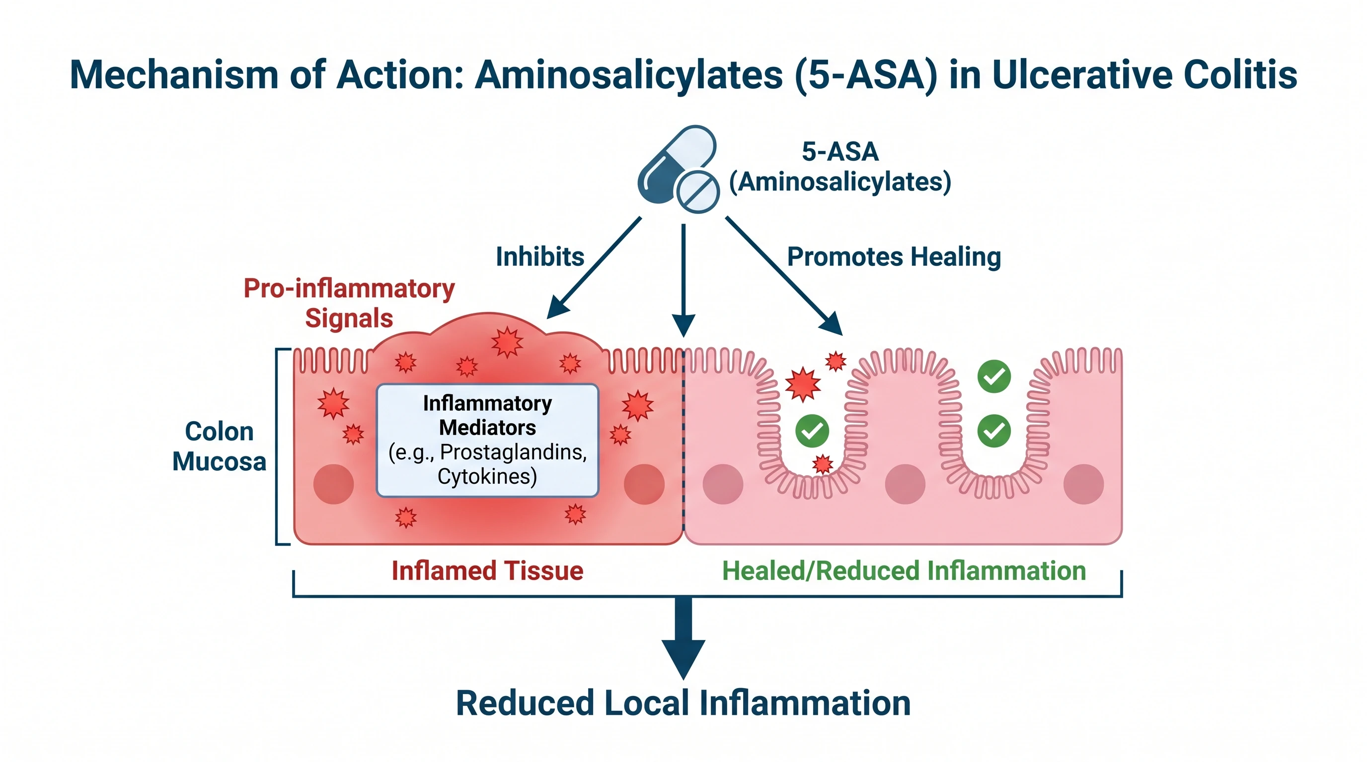 Aminosalicylates (5-ASA) acting on the colon mucosa to reduce inflammation in ulcerative colitis (Figure generated with SciFig)