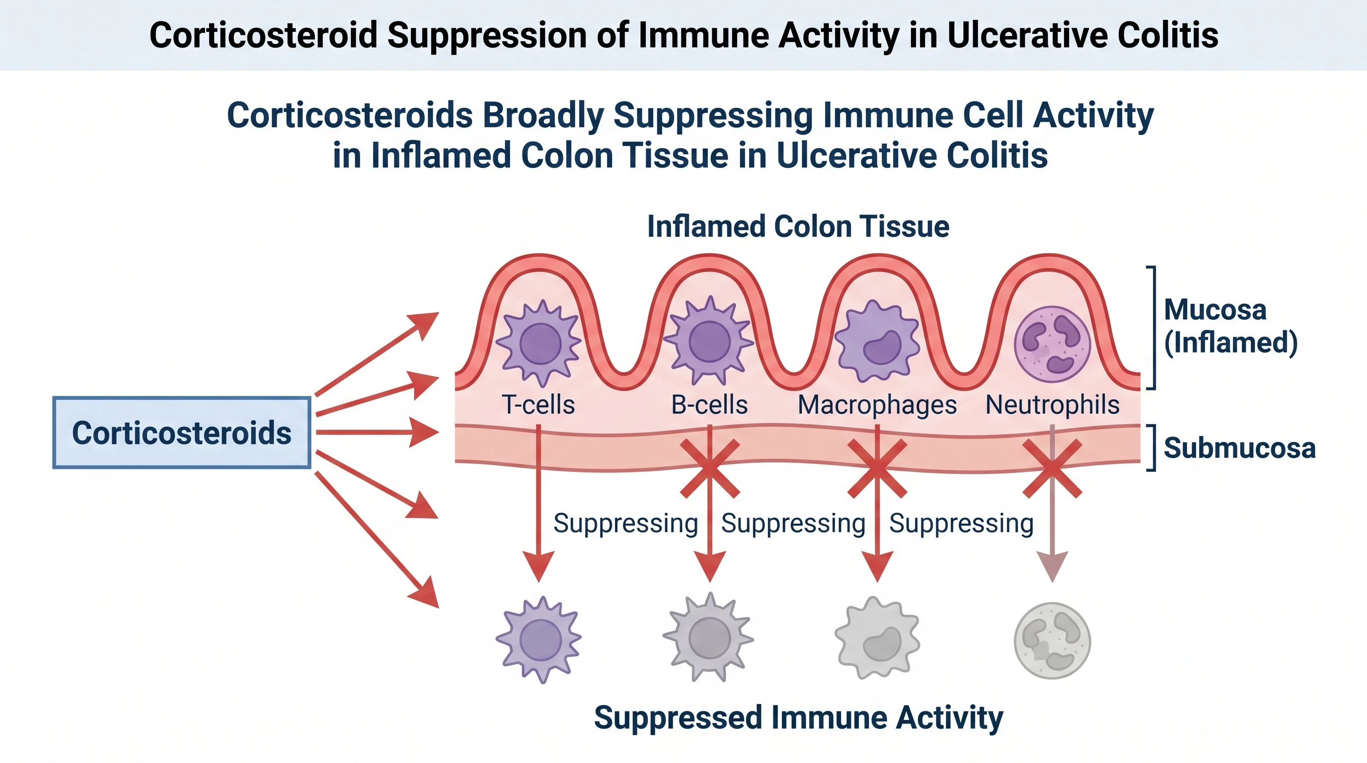 Corticosteroids broadly suppressing immune activity in inflamed colon tissue in ulcerative colitis (Figure generated with SciFig)