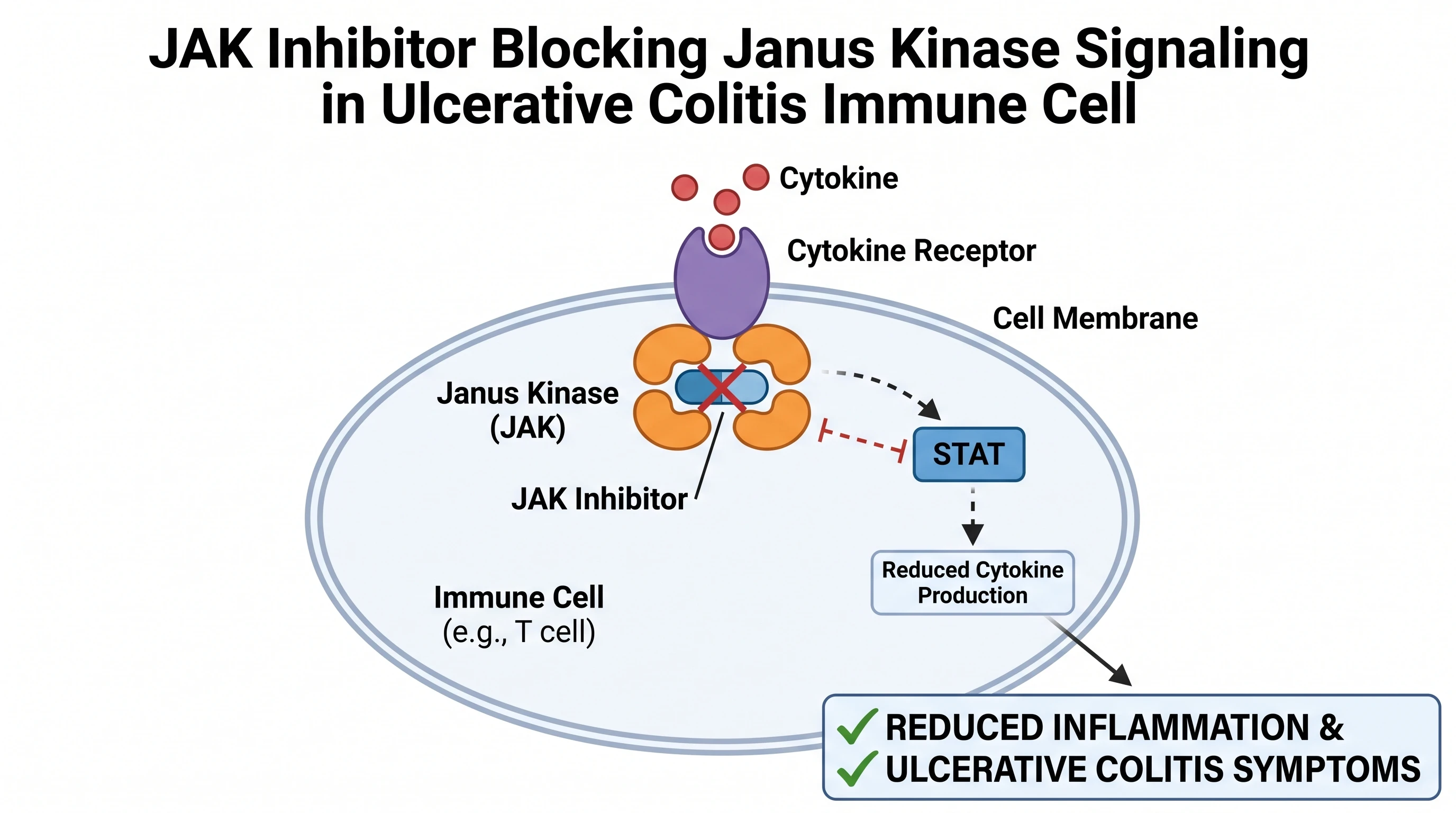 JAK inhibitor blocking Janus kinase signaling to reduce cytokines in ulcerative colitis (Figure generated with SciFig)